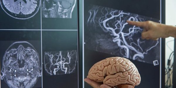 Neurosurgery 3D printed model